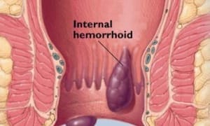 HEMORRHOIDS – EMOTIONAL CAUSES